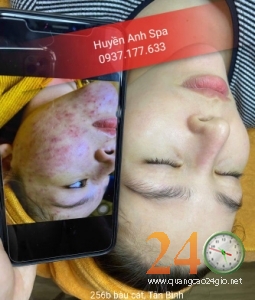 Spa Chăm Sóc Phục Hồi Da Mụn Hiệu Qủa Uy Tín Tân Bình